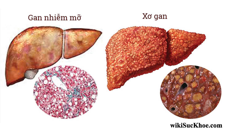 Gan nhiễm mỡ và gan khỏe mạnh